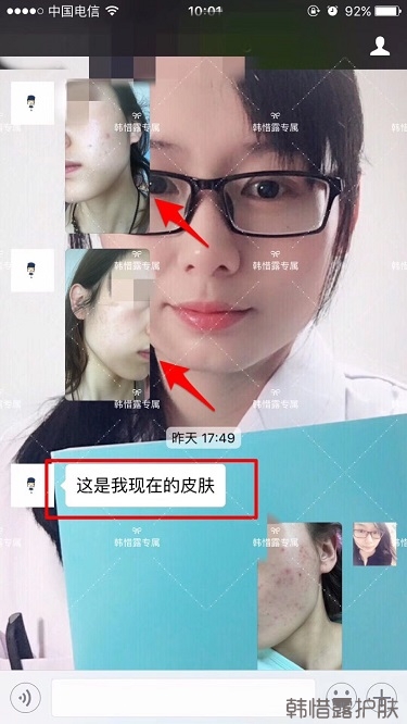 痘痘好了皮膚美麗，不想再記起曾經(jīng)滿臉痘痘的自己！