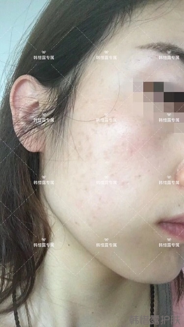 痘痘好了皮膚美麗，不想再記起曾經(jīng)滿臉痘痘的自己！