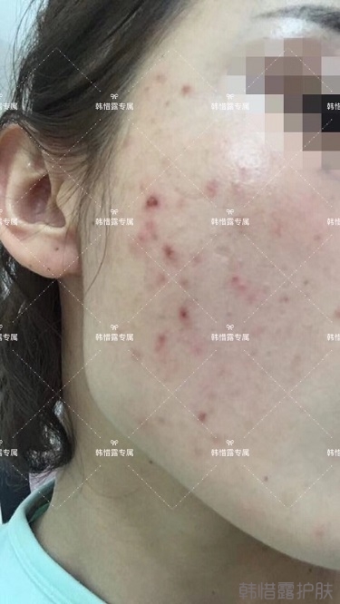 痘痘好了皮膚美麗，不想再記起曾經(jīng)滿臉痘痘的自己！
