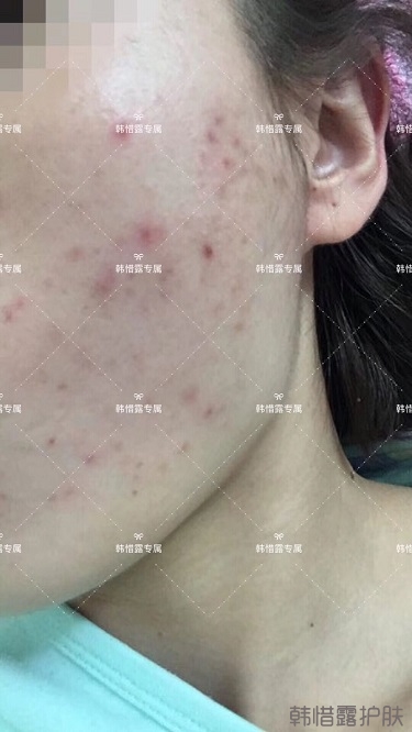 痘痘好了皮膚美麗，不想再記起曾經(jīng)滿臉痘痘的自己！