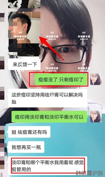 痘印怎么去？痘印調理案例，痘印淡化了
