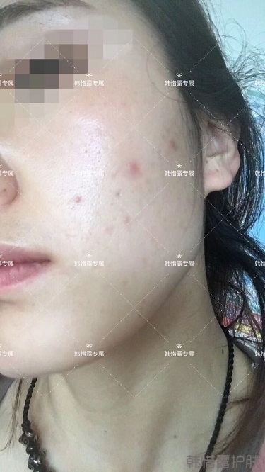痘痘好了皮膚美麗，不想再記起曾經(jīng)滿臉痘痘的自己！
