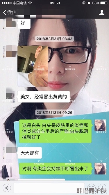 膿包結節發硬痘痘全消了，帥哥開心的來反饋了！