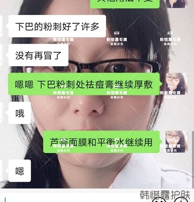 閉口粉刺怎么去除，下巴粉刺好了許多，粉刺沒(méi)有再長(zhǎng)了