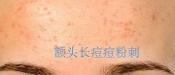 額頭長痘，臉頰長痘痘粉刺，就這樣恢復嫩白肌膚！