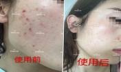 痘痘好了皮膚美麗，不想再記起曾經(jīng)滿臉痘痘的自己！