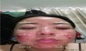 【祛痘視頻反饋】激素臉長痘20多年，大膿包，發癢，完全恢復！