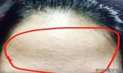 怎么才能去掉閉口痘痘呢？