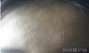 臉上長粉刺了能用祛痘精華嗎？有效果嗎？