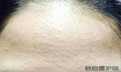 如何去除額頭的粉刺？