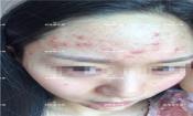 臉上長粉刺怎樣去掉？醫院都沒搞定韓惜露幫我搞定了，超級開心！【視頻】