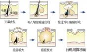 有去痘印最有效的方法嗎？