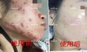 下巴長痘怎么辦？膿包痘祛痘效果，擁有干凈的臉不等待！