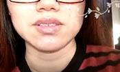 【祛痘視頻反饋】經期容易長痘，讓人很絕望，現在已經沒有痘痘了。
